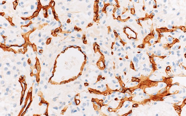 5C2 Hemangioblastoma, VHL (Case 5) CD34 40X