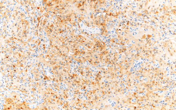 5D1 Hemangioblastoma, VHL (Case 5) Inhibin 20X