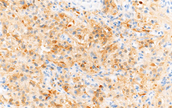 5D2 Hemangioblastoma, VHL (Case 5) Inhibin 40X