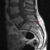 6A1 Hemangioblastomas (VHL) (Case 6) T1 3 cropped copy - Copy - Copy