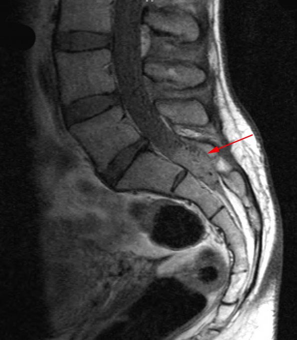 6A1 Hemangioblastomas (VHL) (Case 6) T1 3 cropped copy - Copy - Copy