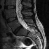 6A3 Hemangioblastomas (VHL) (Case 6) T2 1 (2) cropped - Copy