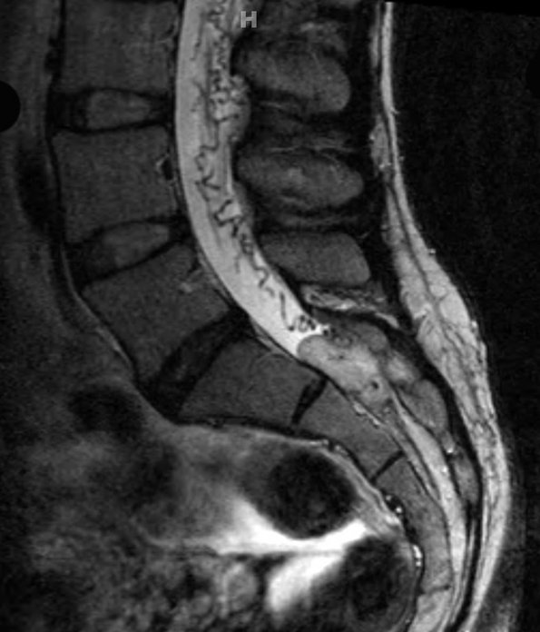 6A3 Hemangioblastomas (VHL) (Case 6) T2 1 (2) cropped - Copy