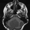 6B1 Hemangioblastomas (VHL) (Case 6) T1 4 - Copy