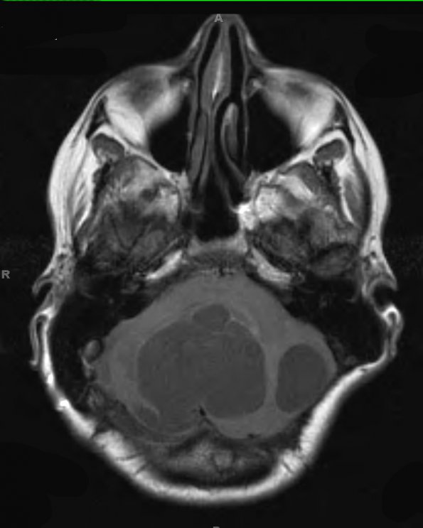 6B1 Hemangioblastomas (VHL) (Case 6) T1 4 - Copy