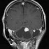 6B2 Hemangioblastomas (VHL) (Case 6) T1 W 2 - Copy