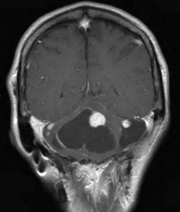 6B2 Hemangioblastomas (VHL) (Case 6) T1 W 2 - Copy