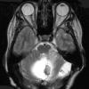 6B3 Hemangioblastomas (VHL) (Case 6) T2 W 1 - Copy