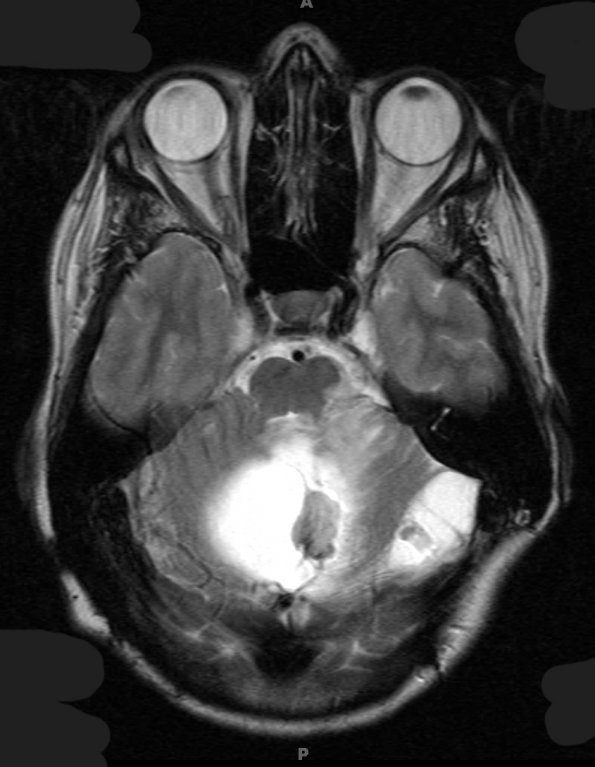 6B3 Hemangioblastomas (VHL) (Case 6) T2 W 1 - Copy