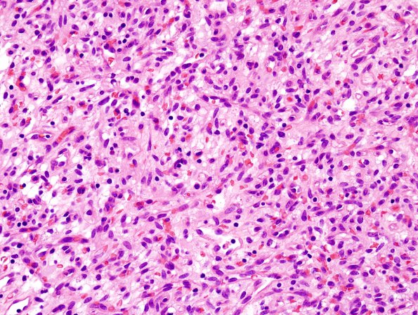 6C2 Hemangioblastomas (VHL) (Case 6) H&E 2