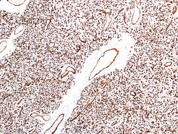 6D1 Hemangioblastomas (VHL) (Case 6) CD34 2