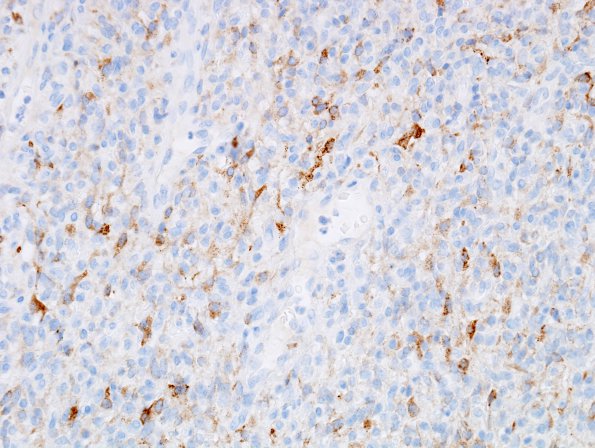 6E1 Hemangioblastomas (VHL) (Case 6) Inhibin 2