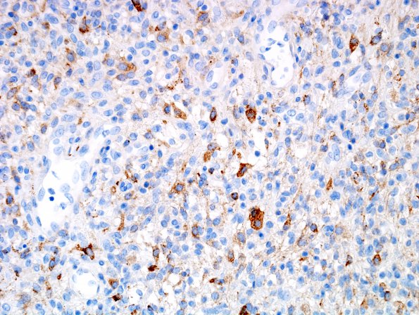 6E2 Hemangioblastomas (VHL) (Case 6) Inhibin 1