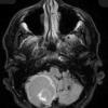 7A1 Hemangioblastoma known VHL (Case 7) FLAIR - Copy