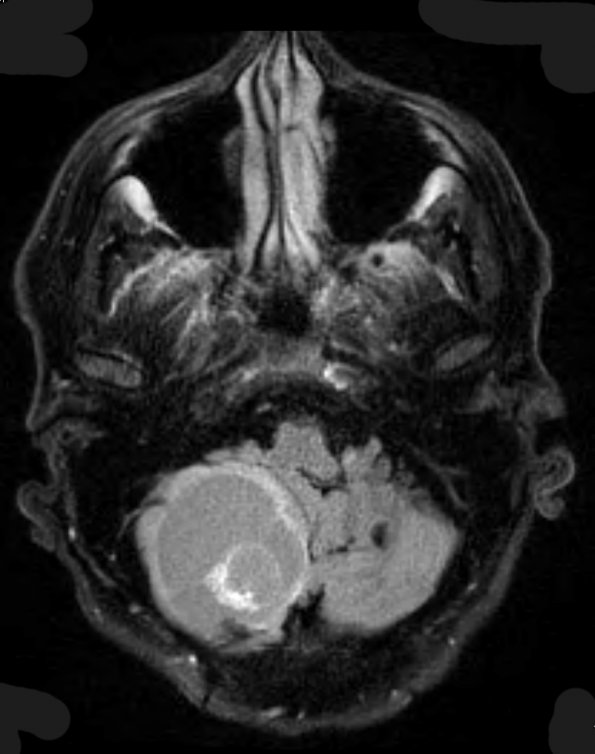 7A1 Hemangioblastoma known VHL (Case 7) FLAIR - Copy