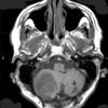 7A2 Hemangioblastoma known VHL (Case 7) T1 1 - Copy