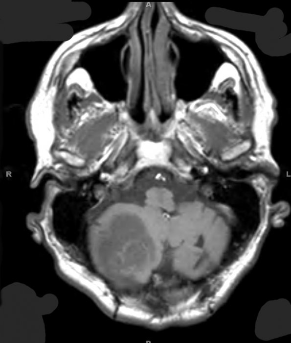 7A2 Hemangioblastoma known VHL (Case 7) T1 1 - Copy