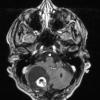 7A3 Hemangioblastoma known VHL (Case 7) T1 W 2 - Copy