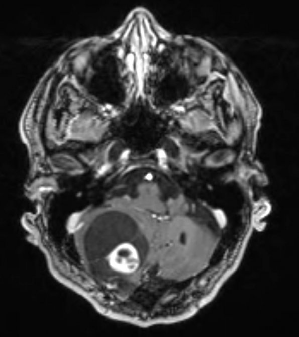 7A3 Hemangioblastoma known VHL (Case 7) T1 W 2 - Copy