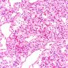 7B1 Hemangioblastoma (Case 7) H&E 20X