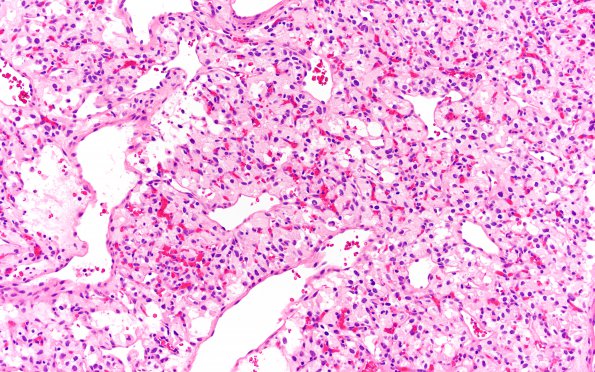 7B1 Hemangioblastoma (Case 7) H&E 20X