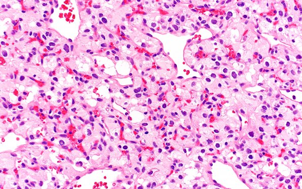 7B2 Hemangioblastoma (Case 7) H&E 40X