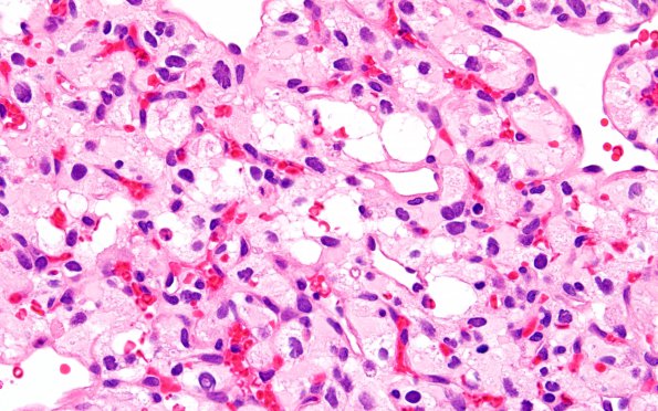 7B3 Hemangioblastoma (Case 7) H&E 60X