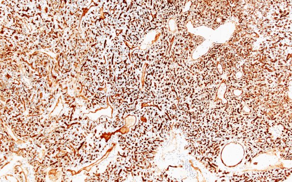 7C1 Hemangioblastoma (Case 7) CD34 10X