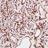 7C2 Hemangioblastoma (Case 7) CD34