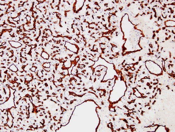 7C2 Hemangioblastoma (Case 7) CD34