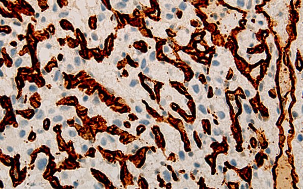 7C3 Hemangioblastoma (Case 7) CD34 60X