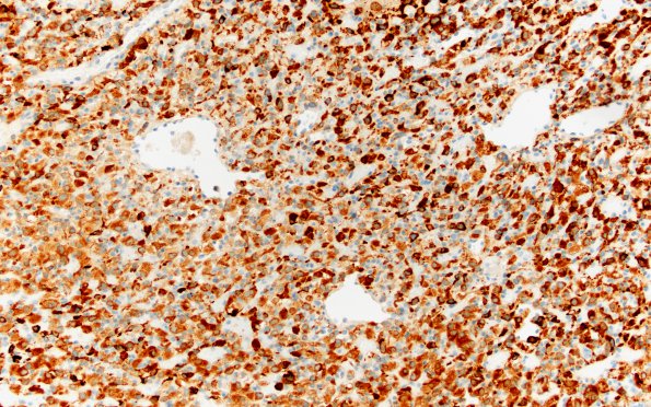 7D1 Hemangioblastoma (Case 7) Inhibin 20X