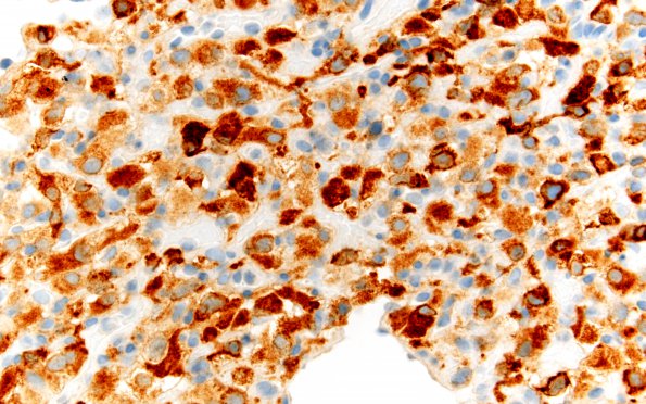 7D2 Hemangioblastoma (Case 7) Inhibin 60X