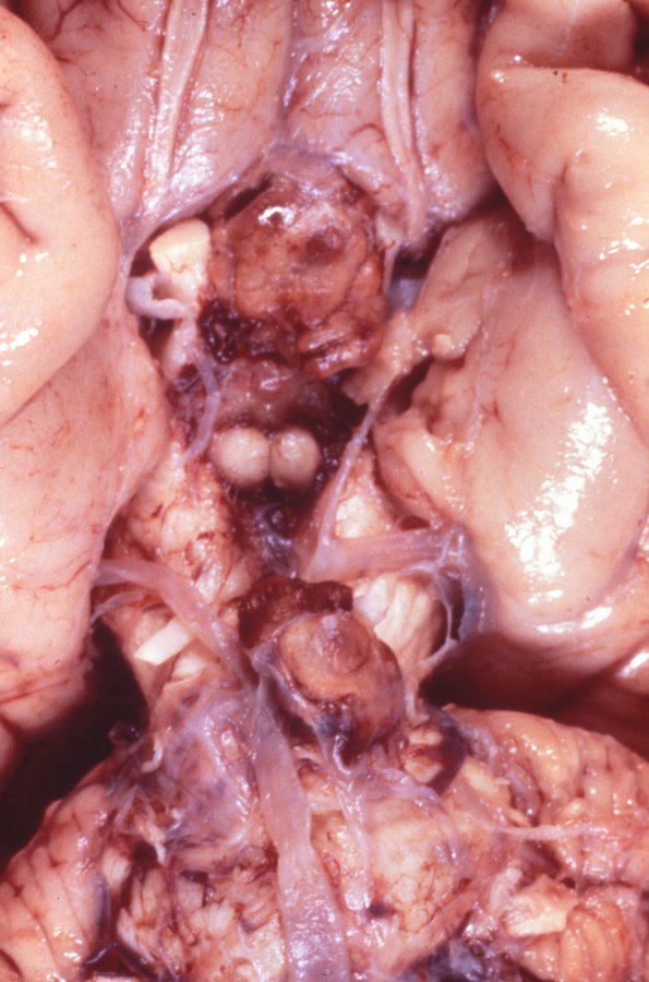 8A2 (Case 8) VHL Closeup ventral surface