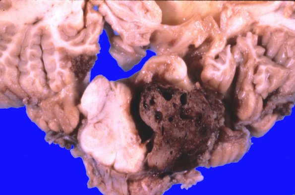 8B2 Hemangioblastoma (Case 8) gross 4