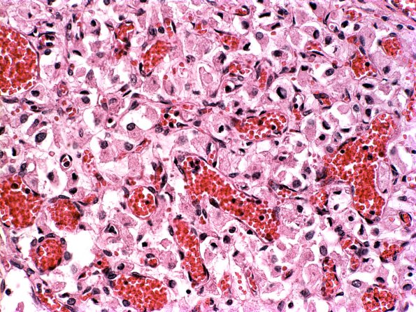 8B6 Hemangioblastoma (Case 8) f