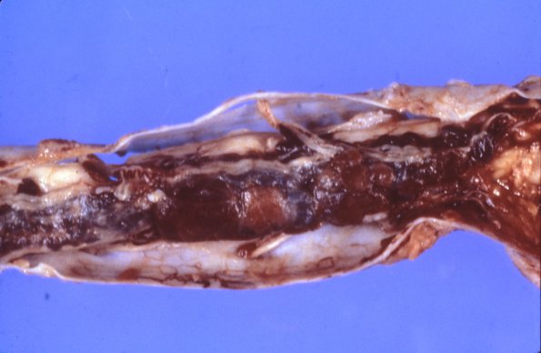 8C2 Hemangioblastoma (Case 8) gross 6