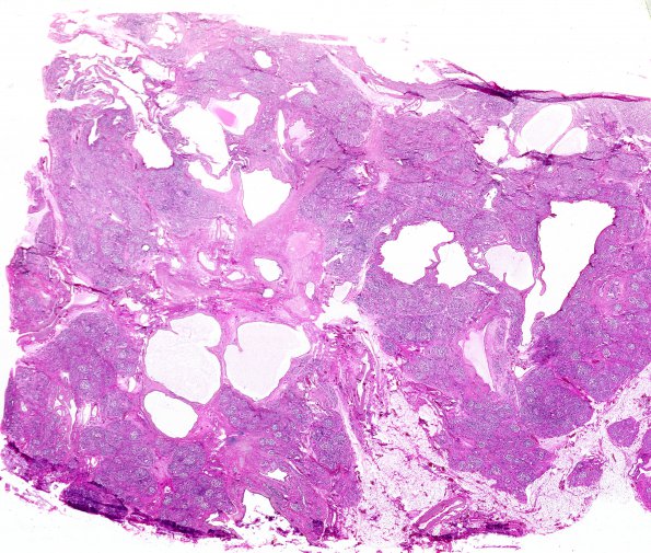 8D2 (Case 8) Pancreas