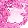 8D3 (Case 8) VHL Pancreas 10X