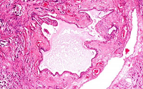 8D3 (Case 8) VHL Pancreas 10X