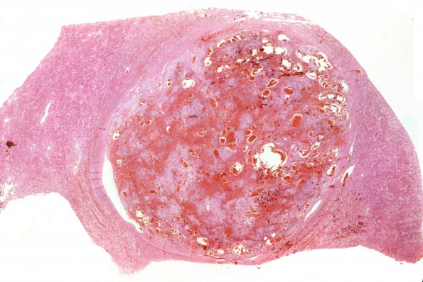 8E (Case 8) VHL Renal