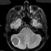 9A1 Hemangioblastoma, VHL (Case 9) FLAIR - Copy