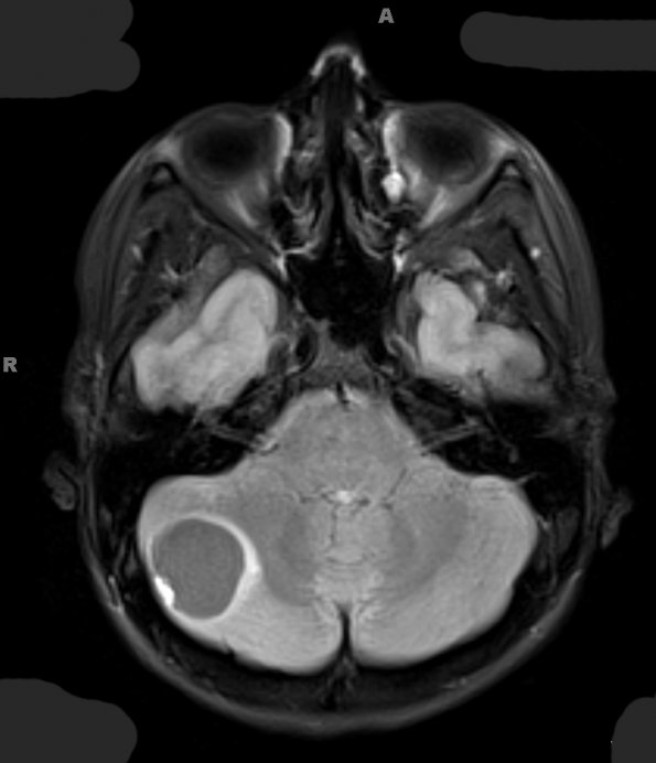 9A1 Hemangioblastoma, VHL (Case 9) FLAIR - Copy