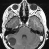 9A2 Hemangioblastoma, VHL (Case 9) T1 W 1 - Copy