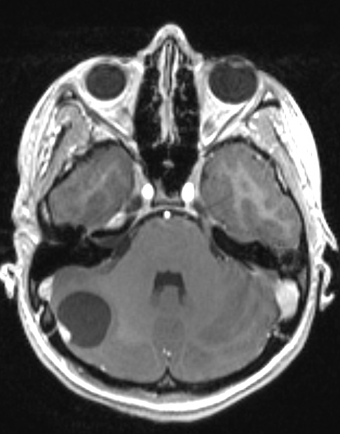 9A2 Hemangioblastoma, VHL (Case 9) T1 W 1 - Copy