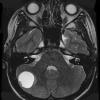 9A3 Hemangioblastoma, VHL (Case 9) T2 1 - Copy