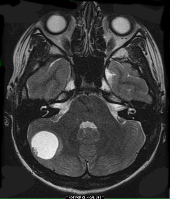 9A3 Hemangioblastoma, VHL (Case 9) T2 1 - Copy