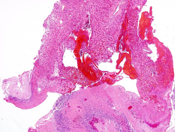 9B1 Hemangioblastoma, VHL (Case 9) H&E 1