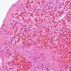 9B2 Hemangioblastoma, VHL (Case 9) H&E 2