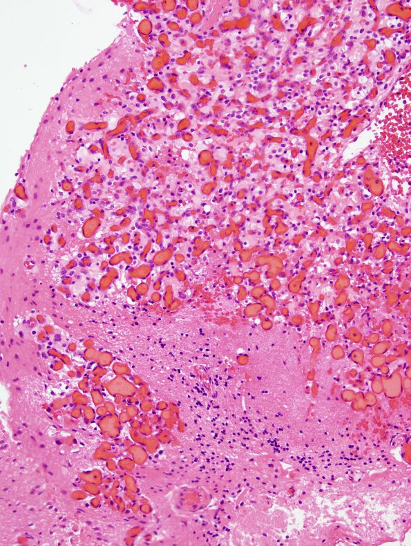 9B2 Hemangioblastoma, VHL (Case 9) H&E 2